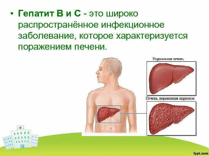 Гепатит с поражение. Инфекционное поражение печени. Печень пораженная гепатитом.