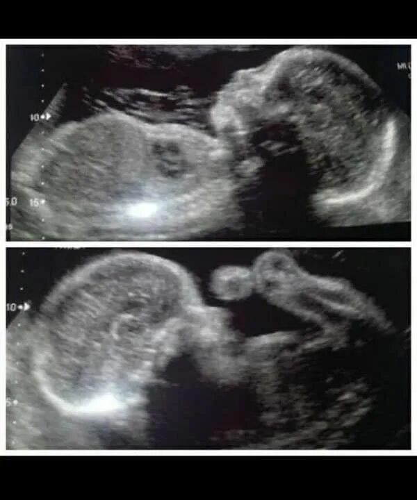Ultrasound at 13 weeks of pregnancy with Triplets. 3d Ultrasound at the 28th week of pregnancy with Triplets. Ultrasound at the 28th week of pregnancy with Twins. 10 недель близнецы