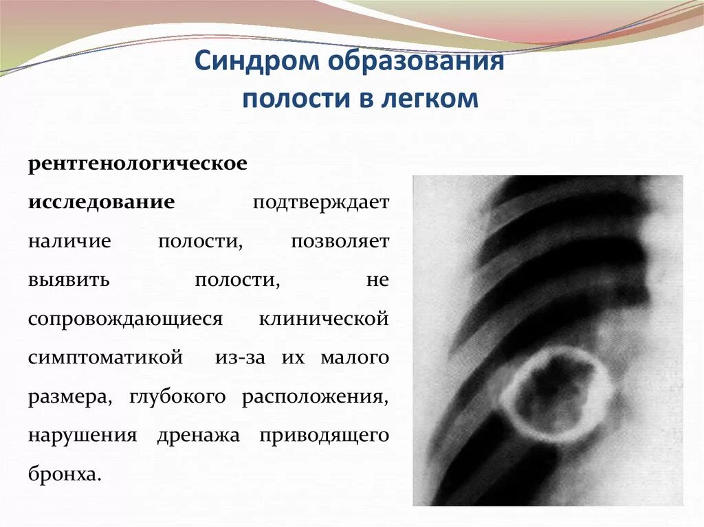 Образование полостей в легких