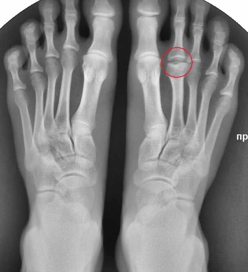 Болезнь Келлера 2 рентген. Болезнь Келлера 1 рентген. Остеохондропатия ладьевидной кости стопы. Болезнь келлера что это такое