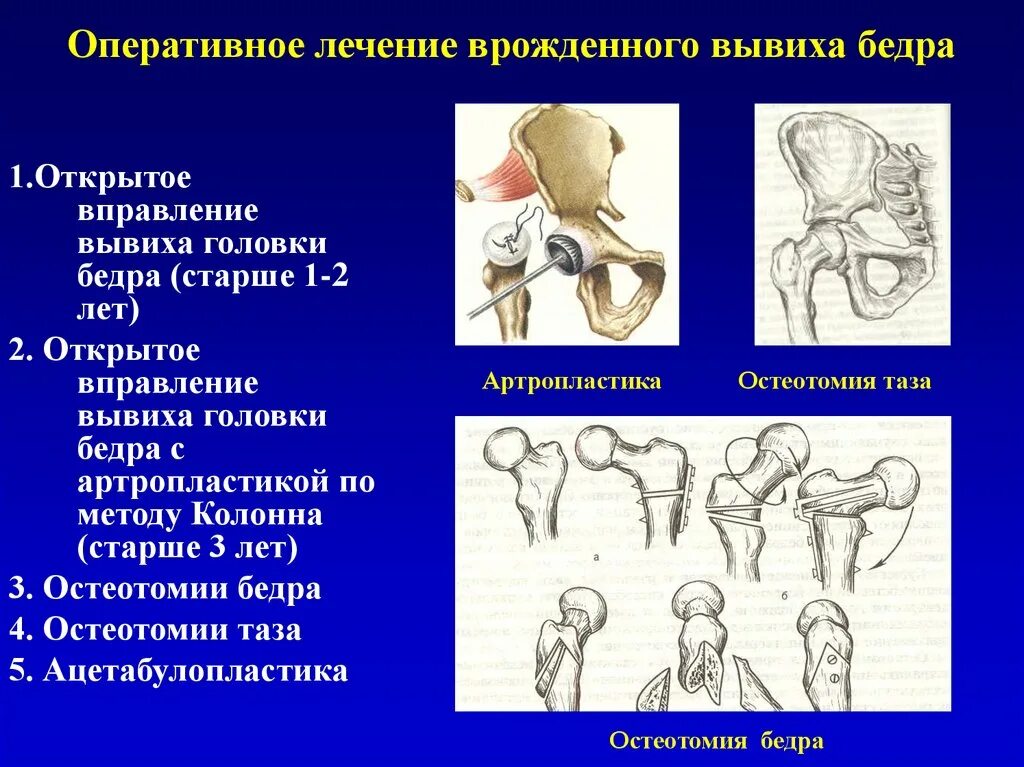 Операции при врожденном вывихе бедра. Подвывих тазобедренного сустава классификация. Операция Солтера при врожденном вывихе бедра. Врожденный вывих бедра классификация.