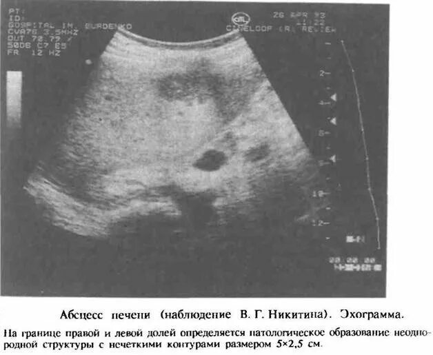 Белое пятно на узи. Абсцесс печени сонография. амебный абсцесс печени на узи. абсцесс брюшной полости на узи. пиогенные абсцессы печени.