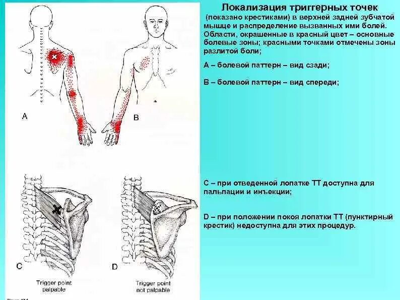 Триггерные точки это простыми словами. Триггерные точки в задней-верхней зубчатой мышце. Триггерные точки зубчатой мышцы. Триггеры грудной мышцы. Задняя зубчатая мышца.