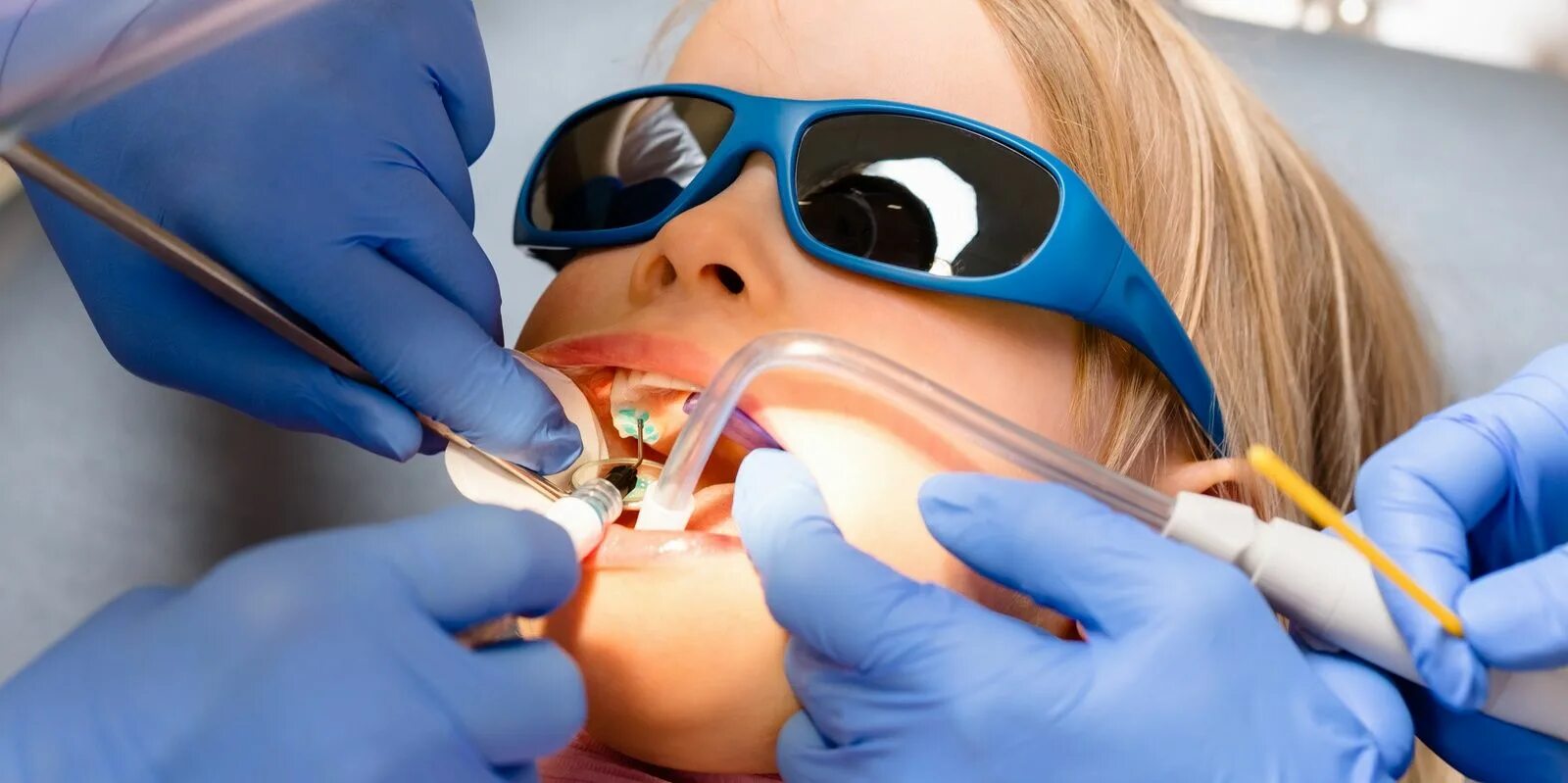 Реминерализационной терапии кариеса. Метод айкон в детской стоматологии. Технология icon в стоматологии. Метод айкон в стоматологии. Методика инвазивной герметизации фиссур.