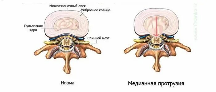 Задняя циркулярная протрузия диска l5-s1. Фораминальная протрузия межпозвонкового диска l4-l5. Протрузия дисков l5-s1 позвоночника. Циркулярная протрузия межпозвонкового диска l4-l5.