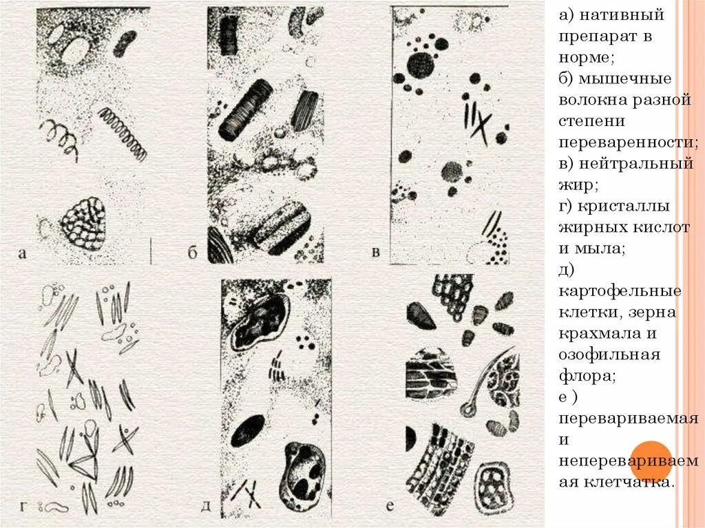 Микроскопия нативного препарата. Микроскопия кала нативный препарат. микроскопия кала детрит. кристаллы жирных кислот микроскопия кала. атлас копрограмма микроскопия.