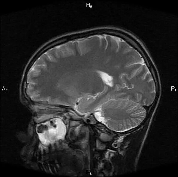 Сосудистый очаг в головном мозге что это. Очаги глиоза на мрт. Глиоз в головном мозге на мрт. Глиоз мрт снимки. Мрт картина очаги глиоза.