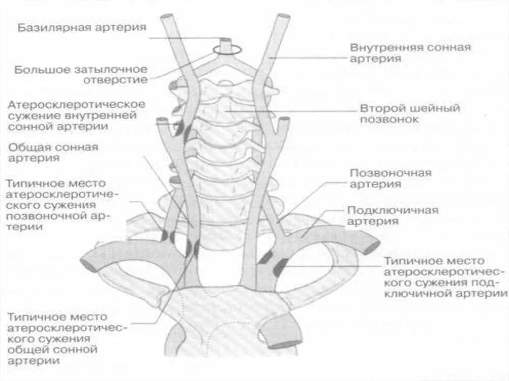 Вертебрально базилярная недостаточность. Гипоплазия v4 сегмента позвоночной артерии. Позвоночная артерия анатомия схема. Позвоночные артерии УЗИ схема. V4 сегмента левой позвоночной артерии.