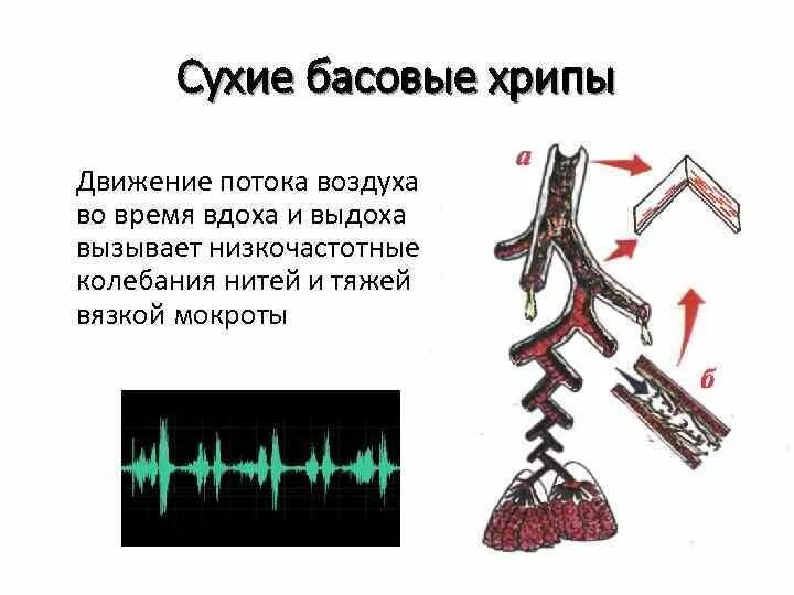 Хрипы в легких звук