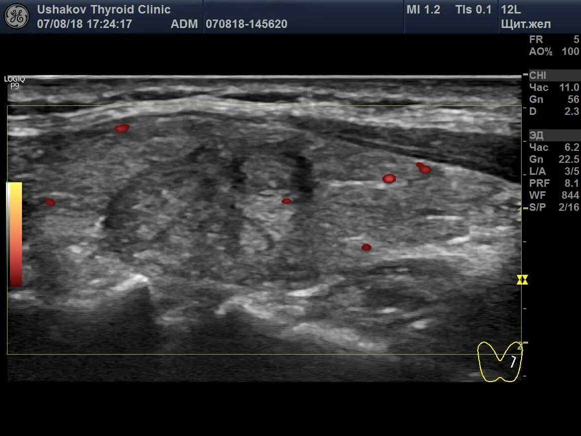 УЗИ мягких тканей протокол УЗИ. Протокол УЗИ щитовидной железы. УЗИ абсцесса мягких тканей протокол. УЗИ мягких тканей бедра протокол. Можно увидеть грыжу на узи