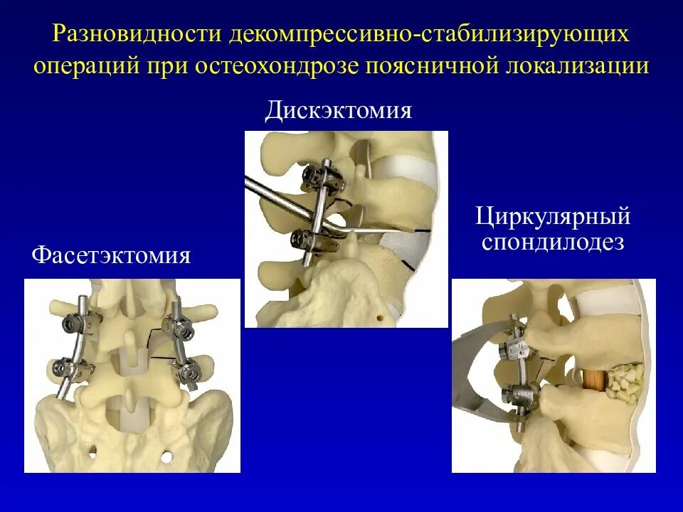 Задний спондилодез l5 l6. Транартикулярная фиксация позвонков поясничного. Спондилодез поясничного отдела позвоночника операция. Декомпрессионная ламинэктомия операция. Конструкция позвоночника операция