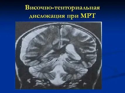 Дислокация головного