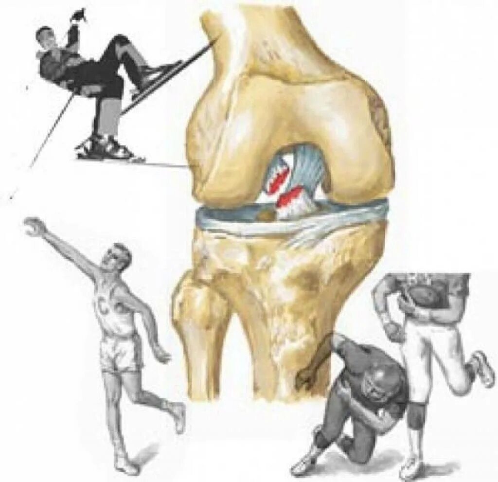 Травма связок сустава. Повреждение ПКС коленного сустава. Травма крестообразной связки коленного сустава. Травма ПКС коленного сустава. Разрыв ПКС коленного сустава.