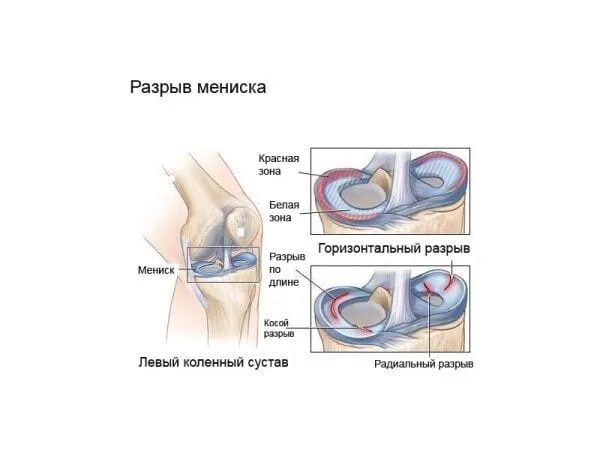 Поврежденный мениск коленного сустава. Разрыв мениска коленного сустава схема. Горизонтальный разрыв мениска. Повреждение мениска коленного сустава. Разрыв связок и мениска коленного сустава.