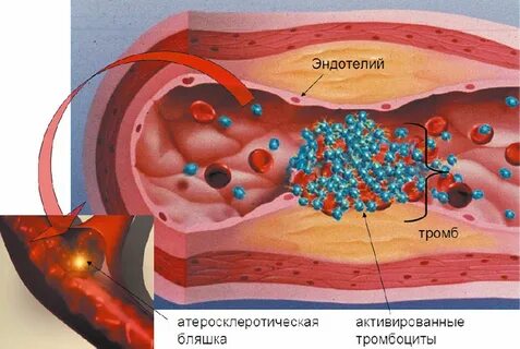 Тромбоз бляшки