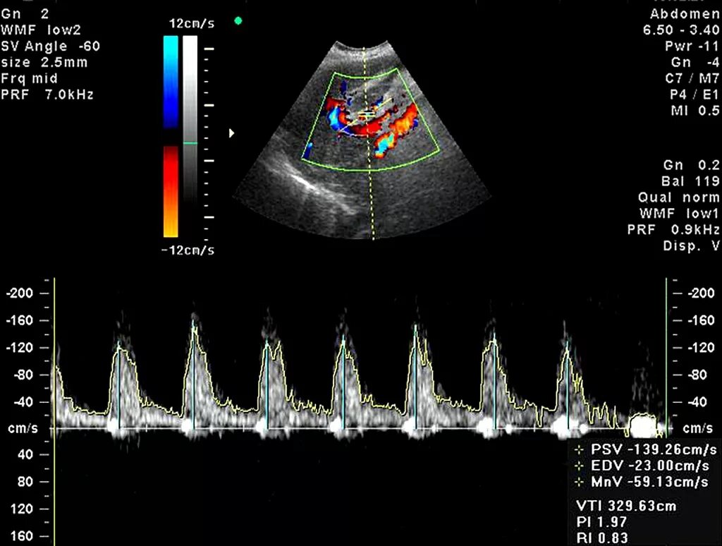Допплерография ребенку. Ультразвуковая допплерография маточно-плацентарного кровотока. Норма кровотока допплер плода. Допплерография сосудов плода. Допплеровское исследование при беременности.