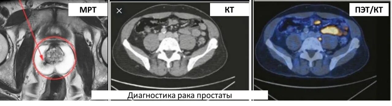 Кт после химиотерапии. ПЭТ кт. ПЭТ кт после химиотерапии. ПЭТ кт мрт. Кт или мрт.