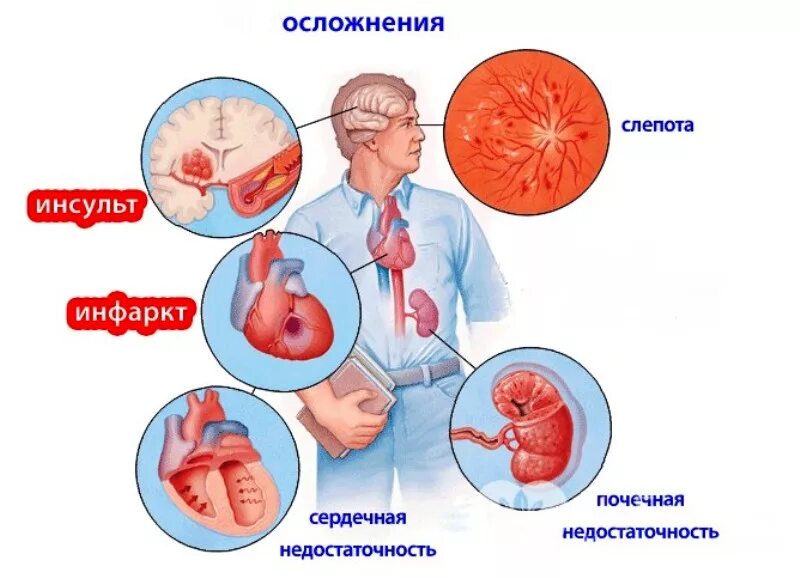 Осложнения аг. ХСН это осложнение гипертонической болезни. Осложнения при артериальной гипертензии 3 степени. Органы мишени артериальной гипертонии. Артериальная гипертония симптомы.