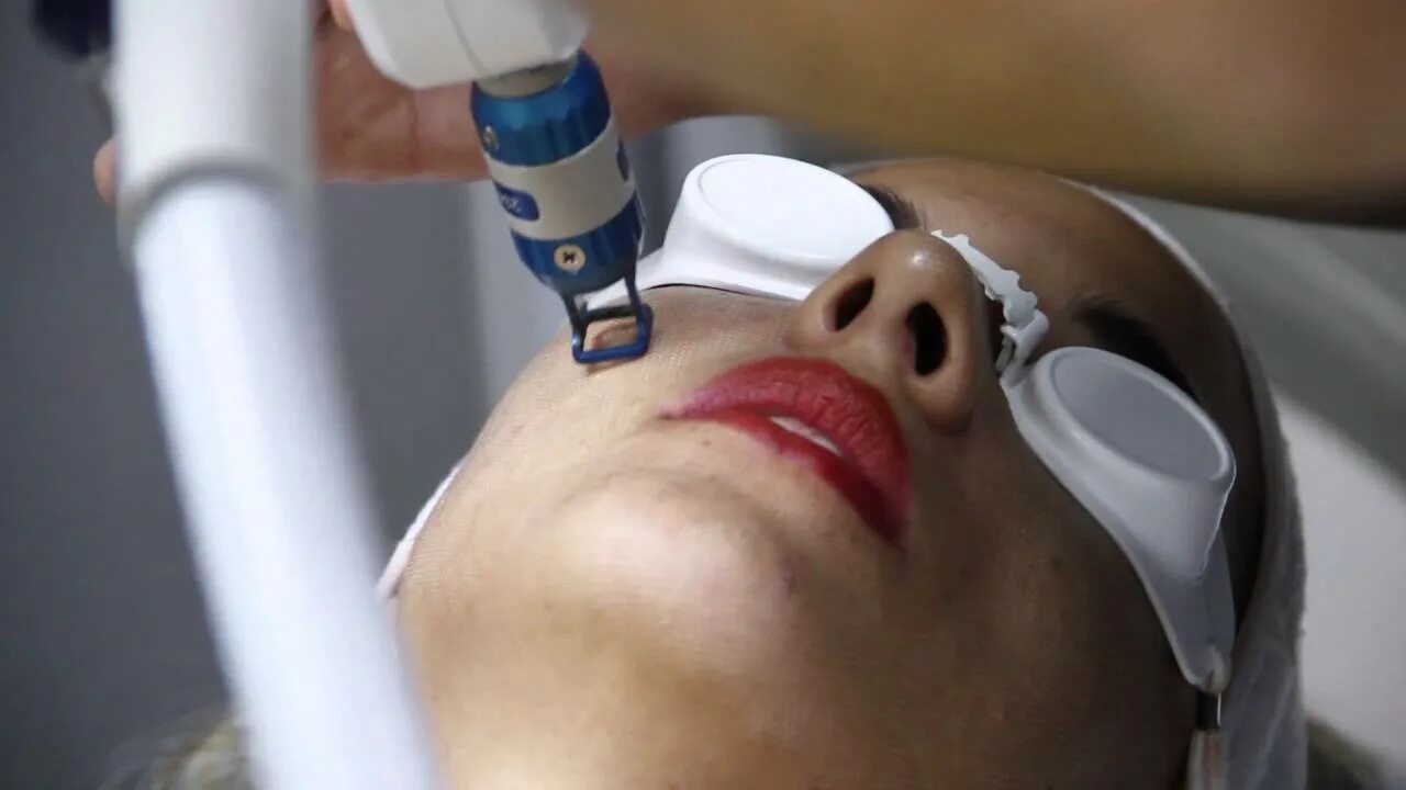 Омоложение сосудов. Аппарат harmony xl pro. harmony xl pro лазер. фотоомоложение harmony xl. неабляционное лазерное омоложение.