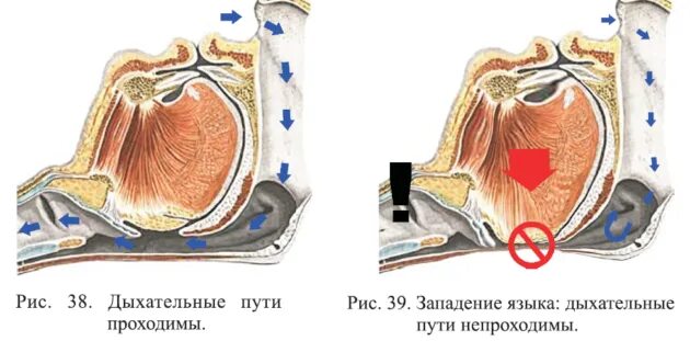 Западения корня языка. Анатомия западения языка.