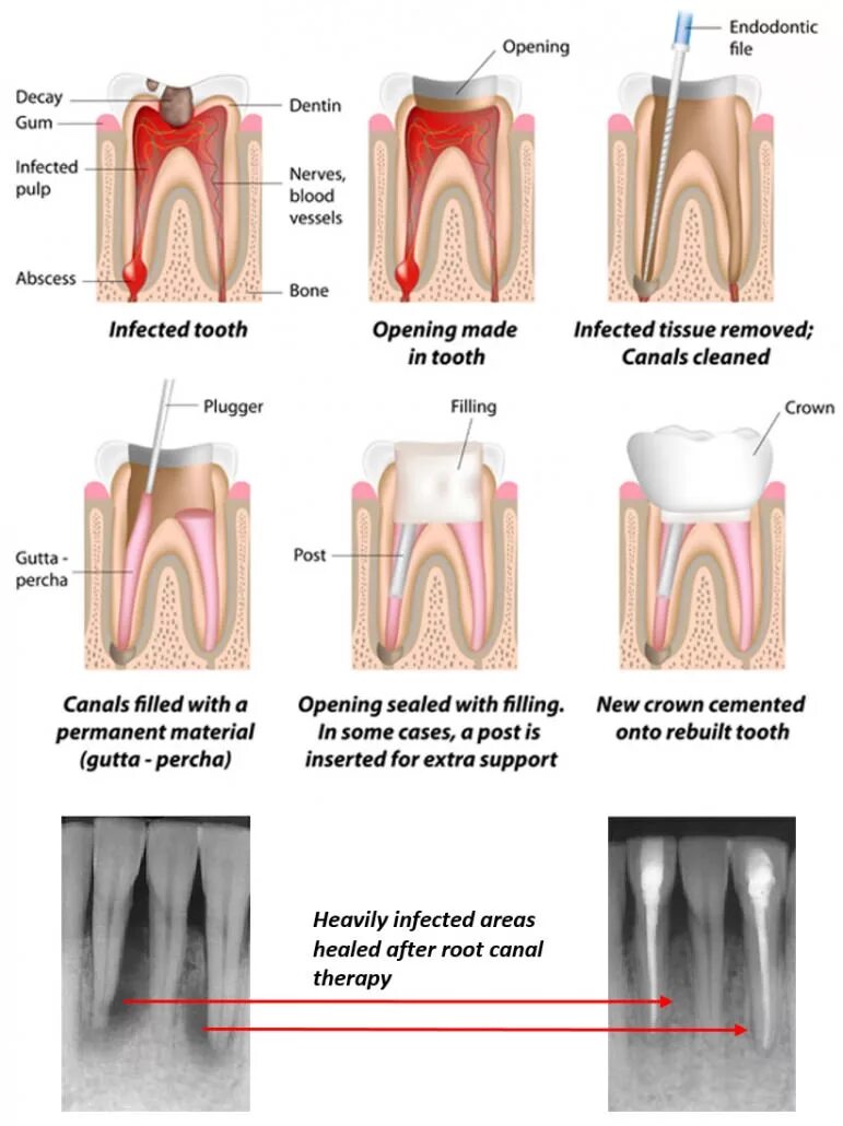 Root canal