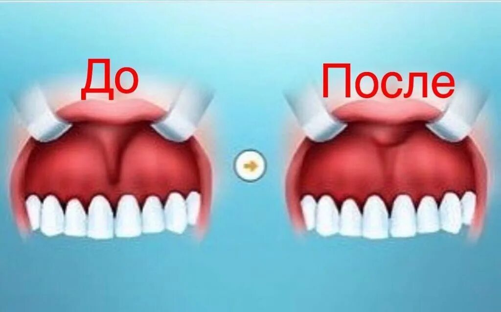 Подрезание уздечки верхней губы. Подрезать уздечку языка. Пирсинг проколы схема с названиями. Короткая уздечка верхней губы. Короткая уздечка языка подрезание.