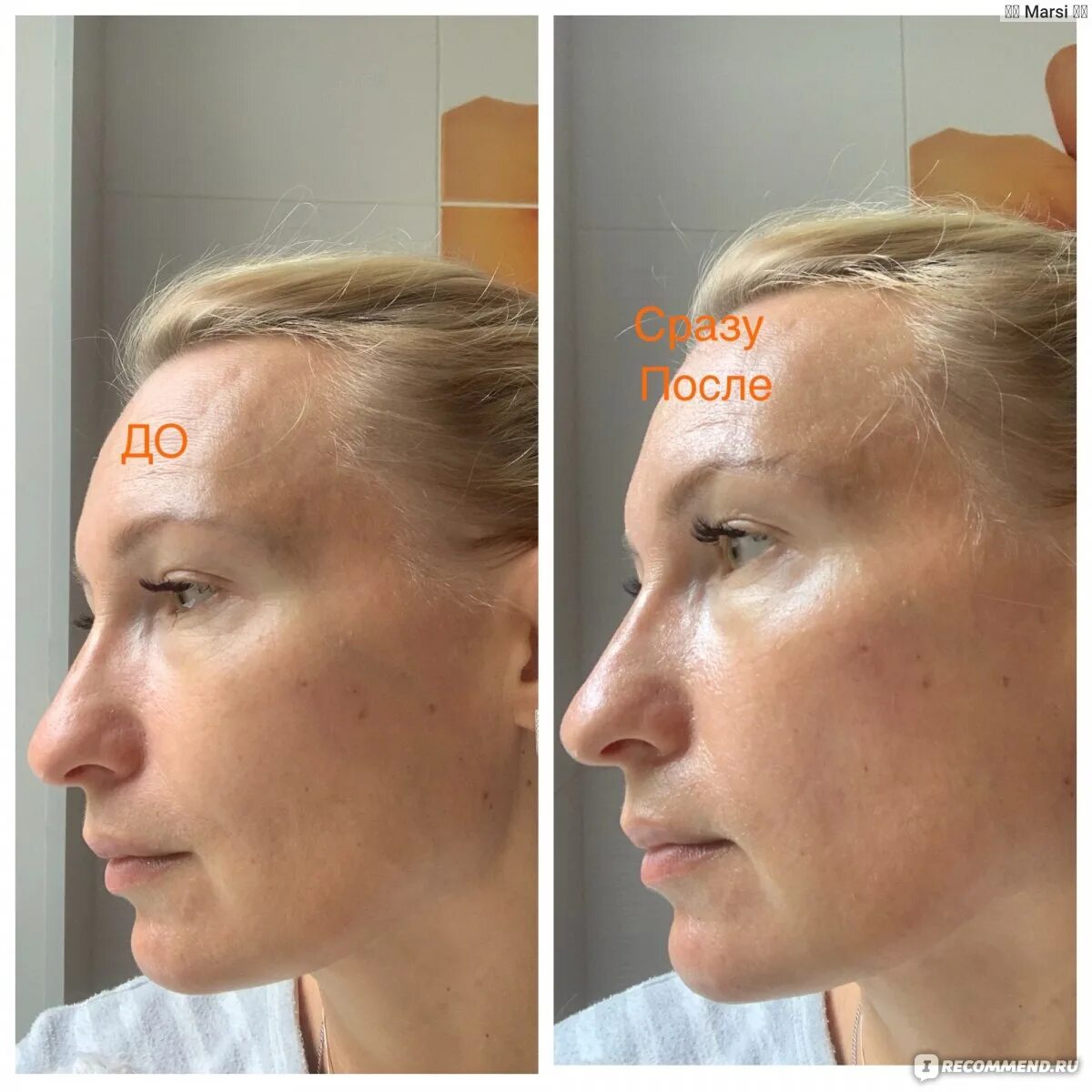Would YOU inject collagen from dead horses into your face to look younger? Daily