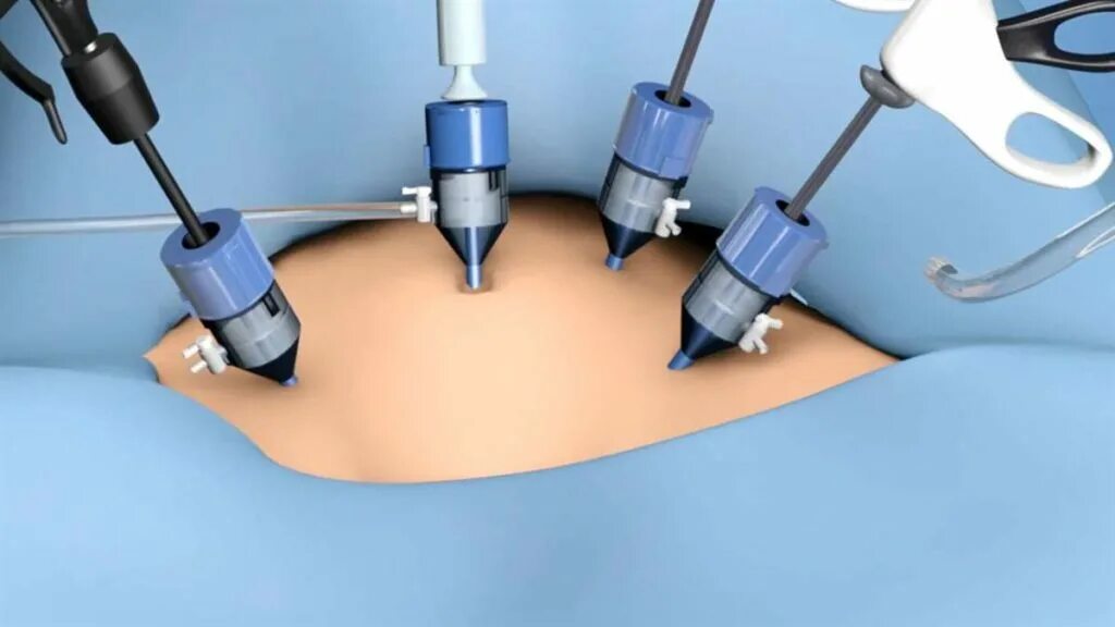 Лапароскопия матки отзывы. Лапароскопия цистэктомия. Лапароскопическая аппендэктомия лапароскопия. Лапароскопия в гинекологии. Лапароскопия в гинекологии проколы.