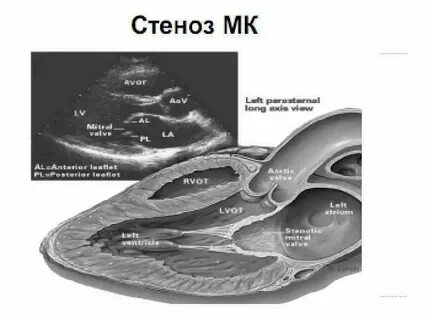Миксоматозная дегенерация
