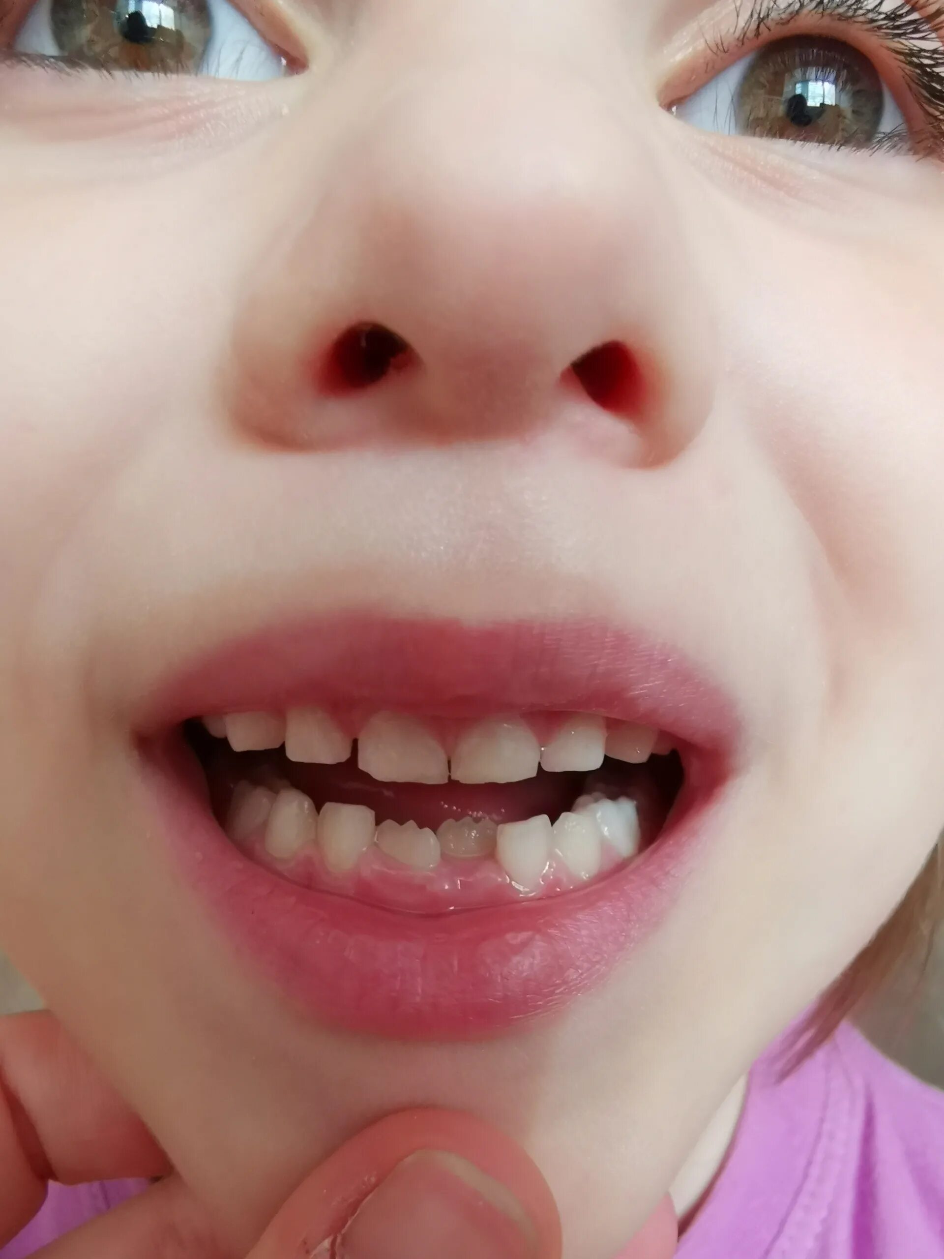 молочные передние выпали растут