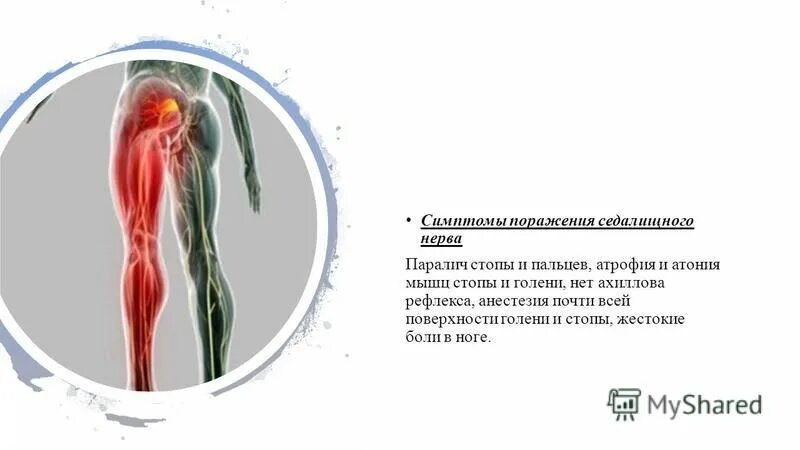 Атония мышц это. Мышечная атония. паралич седалищного нерва. атония всех мышц.