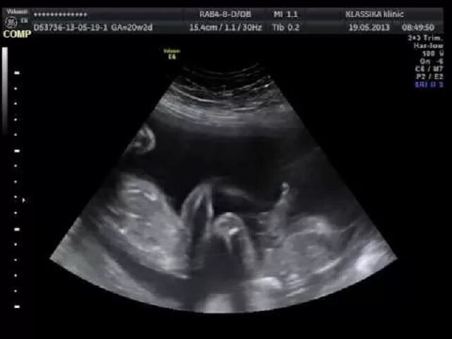 на скрининге увидели двойню. узи 17 недель беременности двойня. на скрининге увидели двойню. 12 неделя многоплодная узи. узи двойни на 12 неделе скрининг.