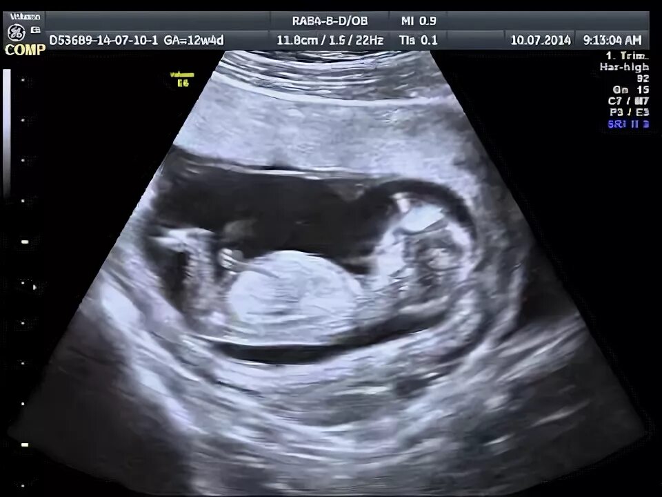 Ребенок в утробе 13 недель. 13 неделя коричневые