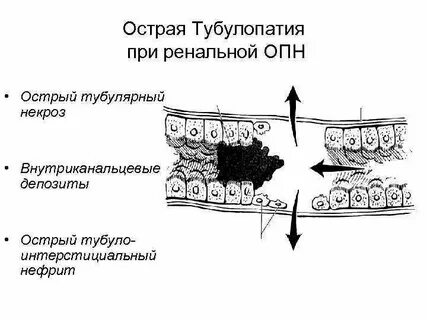 Острый тубулярный некроз почки