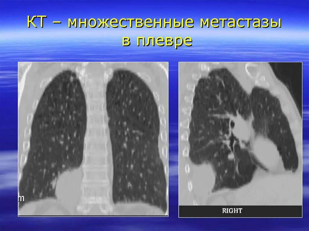 Метастазы меланомы в легкие рентген. Опухоли плевры рентген. Признаки метастаз в легких