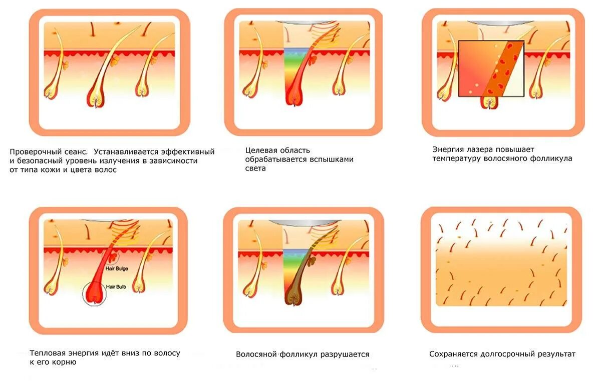 Диодный лазер для эпиляции схема. Как воздействует диодный лазер. Воздействие диодного лазера на волосы. Схема воздействия лазером на волос.