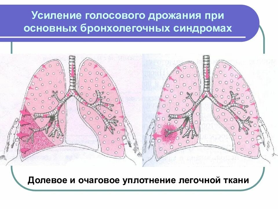 Синдром уплотнения ткани. Синдром уплотнения легочной ткани долевая пневмония. синдром долевого уплотнения легочной ткани пропедевтика. синдром воспалительного уплотнения легочной ткани. синдром уплотнения легочной ткани голосовое дрожание.