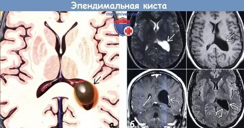 Кисты в мозгу у взрослого причины
