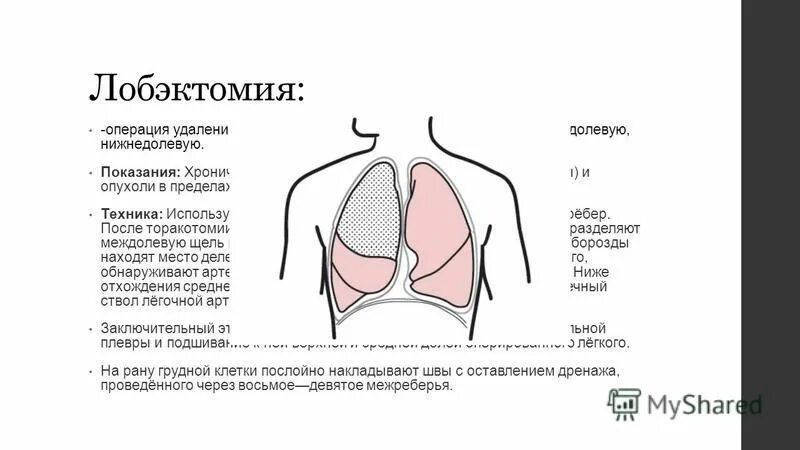 Лобэктомия верхней доли легкого. Лобэктомия что это