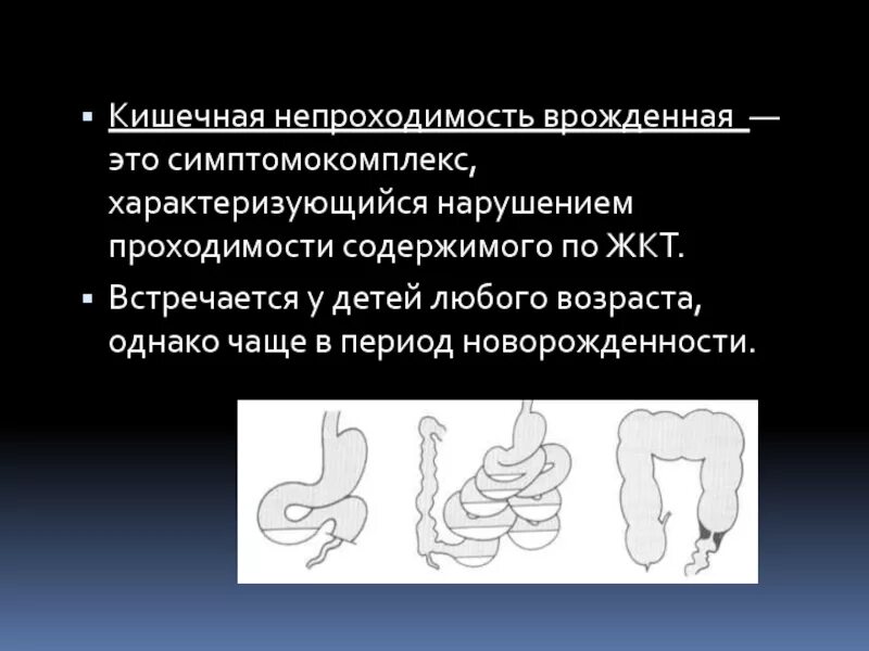 Гипокалиемия кишечная непроходимость. Врожденная кишечная непроходимость. Механическая кишечная непроходимость осложнения. Врожденная кишечная непроходимость классификация.