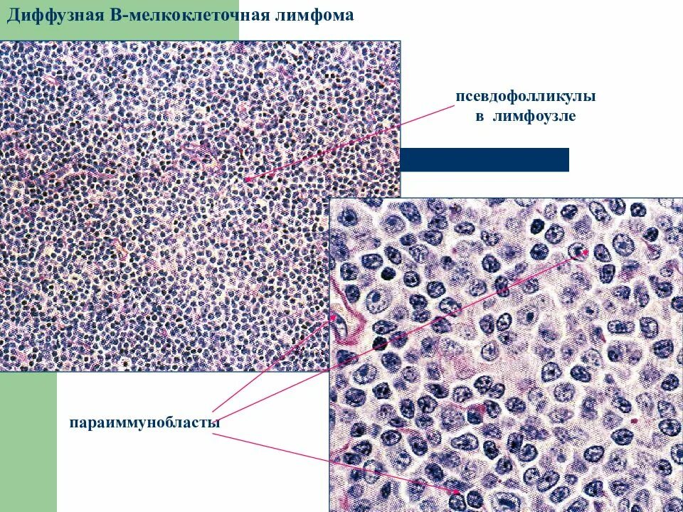 Бета клеточная лимфома. Крупноклеточная лимфома гистология. В клеточная лимфома гистология. B крупноклеточная лимфома cd20 микропрепарат. Диффузная неходжкинская