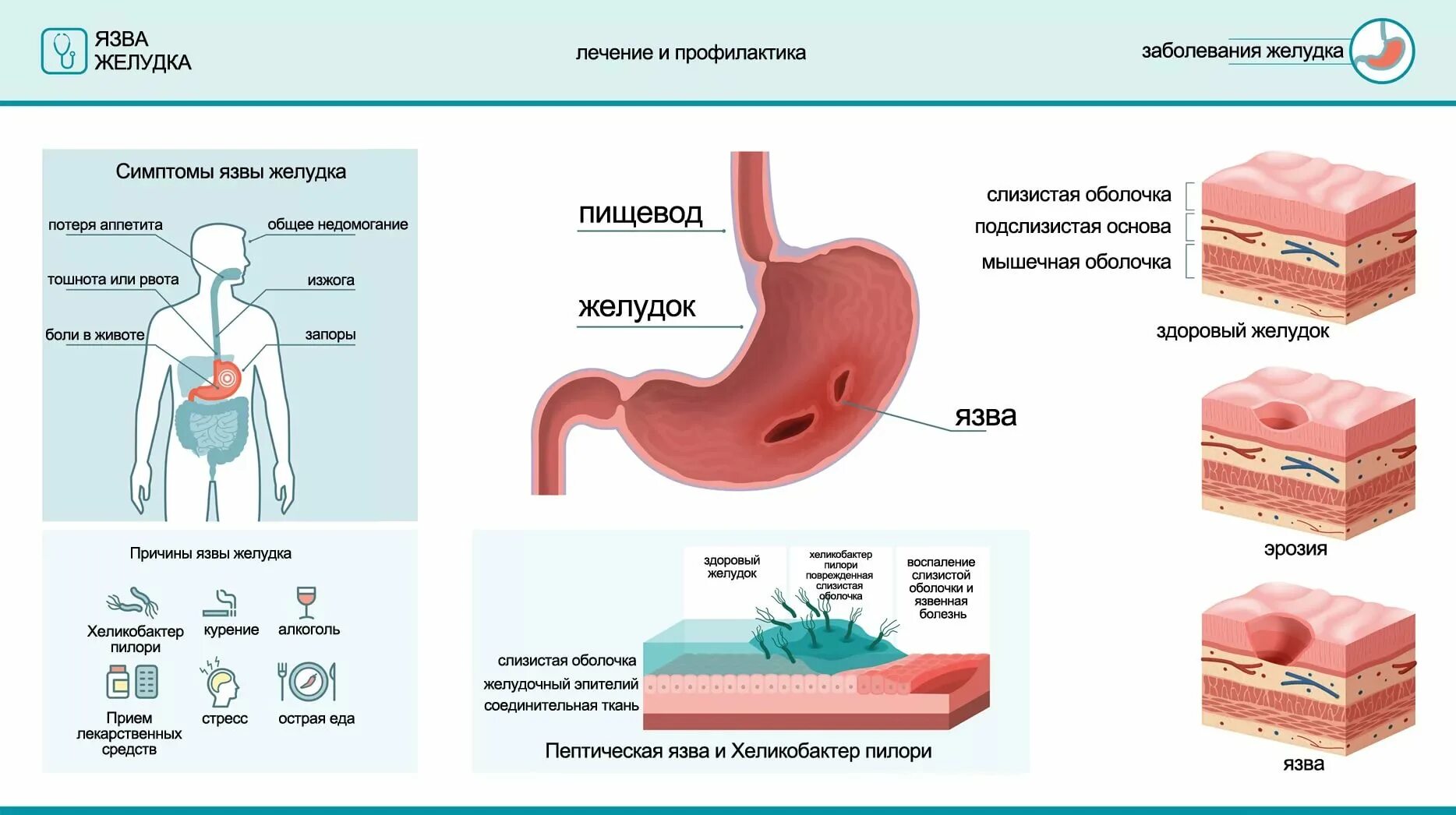 Среда пищевода. Язвенная болезнь желудка и 12-перстной кишки. Гастрит.. Сопутствующие заболевания при язвенной болезни желудка. Стадии развития язвенной болезни желудка. Симптомы язвенной болезни желудка и двенадцатиперстной кишки.