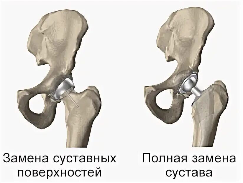 Перелом тазобедренной впадины. Перелом вертлужной впадины классификация. перелом вертлужной впадины. кости вертлужной впадины. перелом вертлужной впадины рентген.