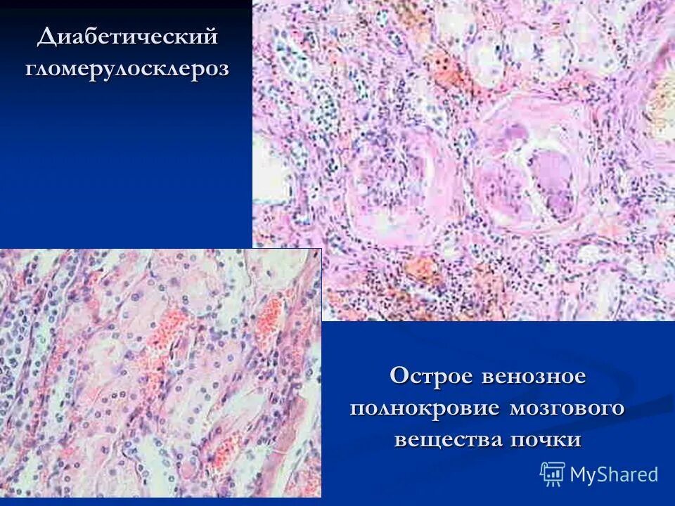 Биоптат слизистой оболочки. Диабетический гломерулосклероз микропрепарат. Микропрепарат полнокровие почки. Узелковый гломерулосклероз микропрепарат. Хроническое венозное полнокровие почки макропрепарат.