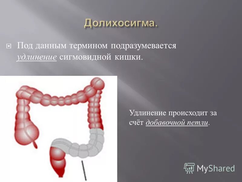 Долихосигма петлистая сигмовидная кишка. Долихосигма кишечника анатомия. Анатомия толстой кишки долихосигма. Сигмовидная кишка долихоколон. Удлинена сигмовидной