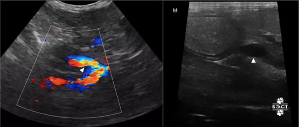 Шунт печени у собак. Артериовенозная мальформация печени. Артериовенозная мальформация печени на кт. Портальные шунты на УЗИ. Артериовенозная мальформация на УЗИ.