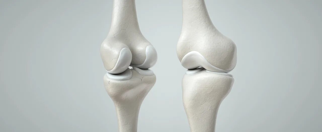 Белое колено что это. Cartilage. Как выглядят колени при артрозе. Артрит синовит коленного сустава. Белое колено что это.