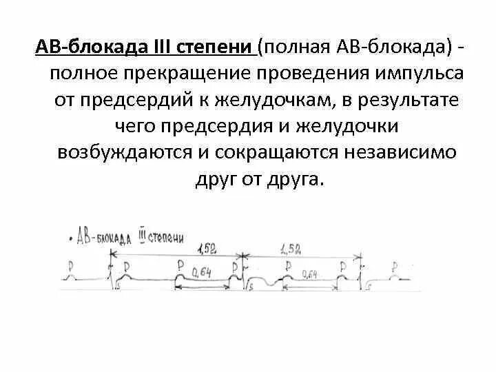 Блокада код по мкб 10. АВ блокада 2 ст мкб. Av блокада мкб 10. Атриовентрикулярная блокада 3 ст мкб 10. Полная av-блокада III степени.