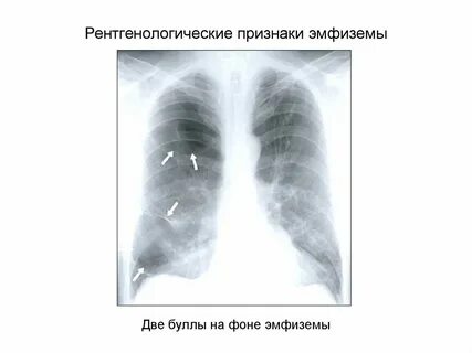 Хобл эмфизема