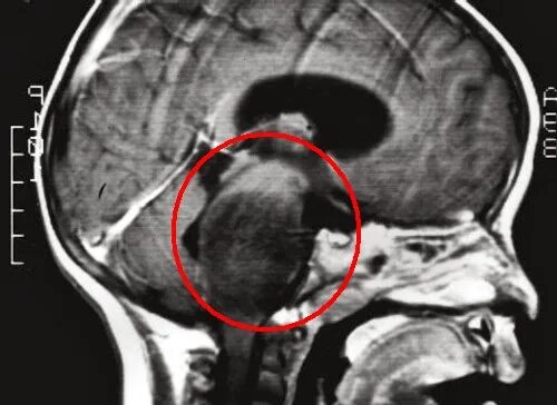 Рак ствола головного мозга. Диффузная глиома ствола. Глиома ствола мозга мрт. Неоперабельная глиома. Неоперабельная глиома ствола головного мозга.